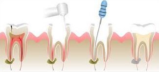 root-canal-2